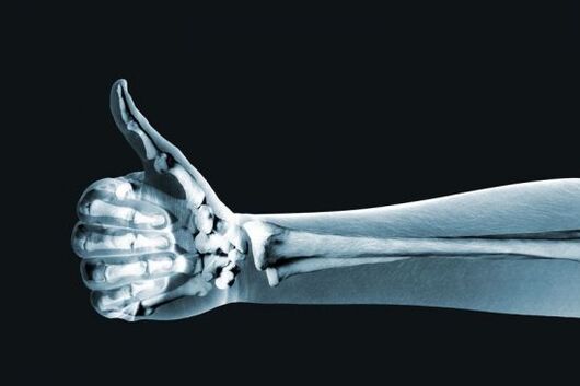 Parmak eklemlerindeki ağrıyı teşhis etmek için röntgen