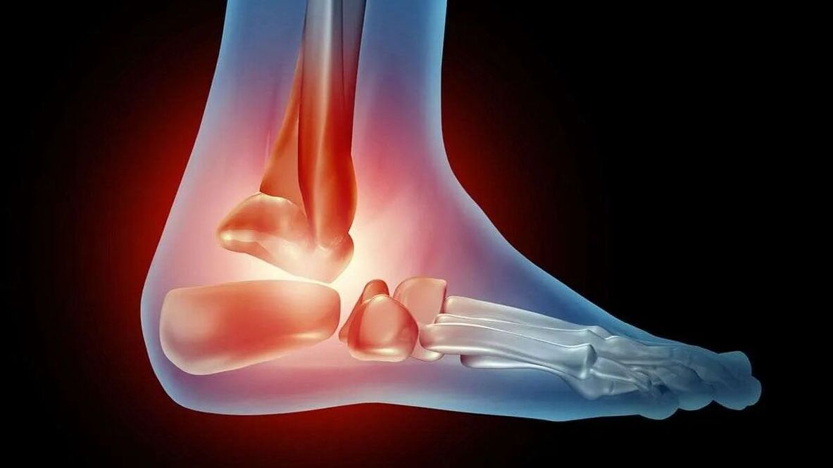 ayak bileği artroz diyagramı