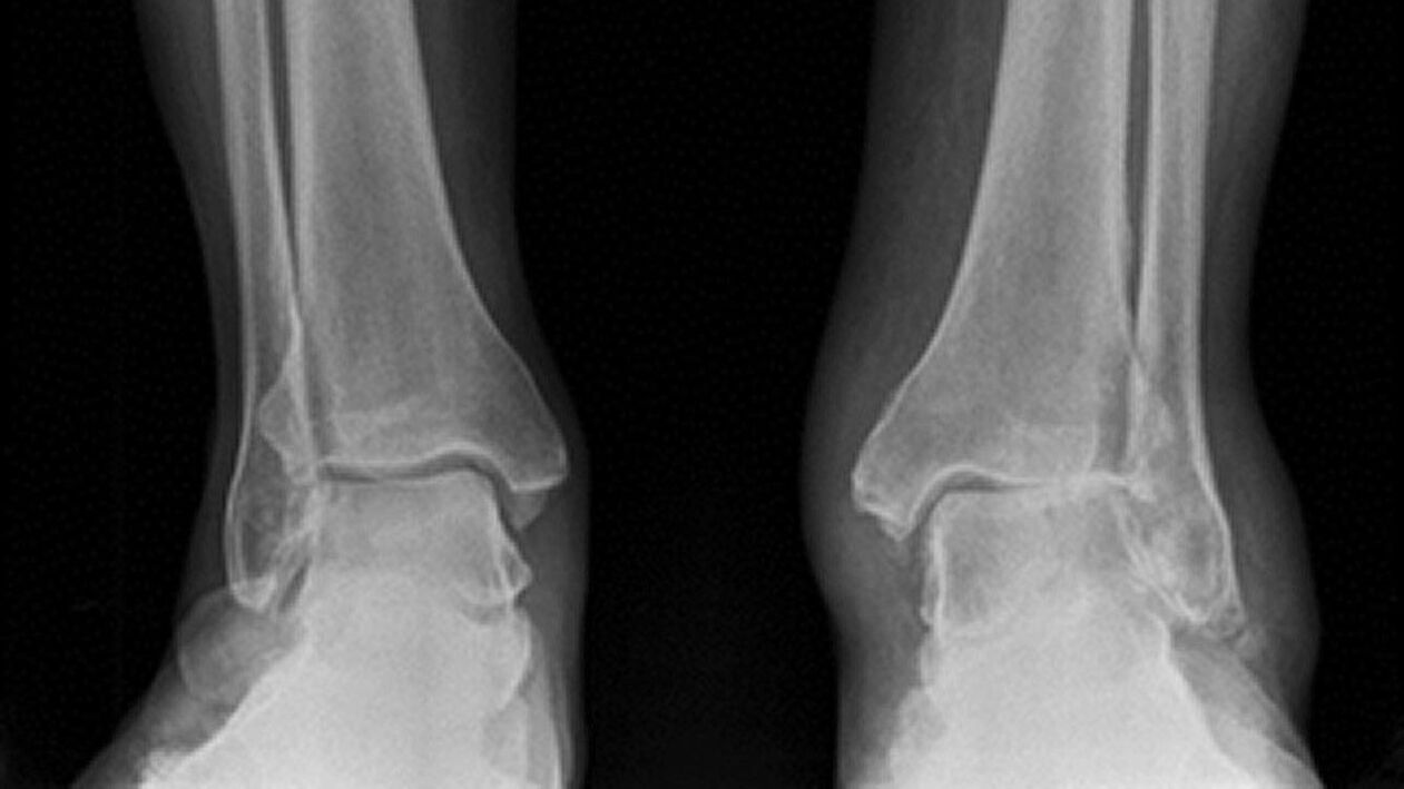 ayak bileği röntgeni