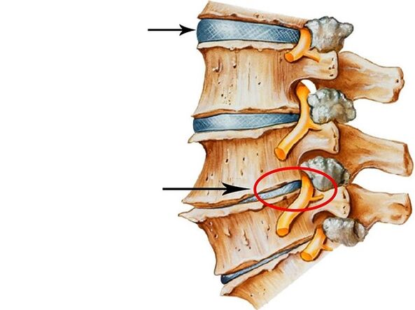 İntervertebral disklerde bozukluklar