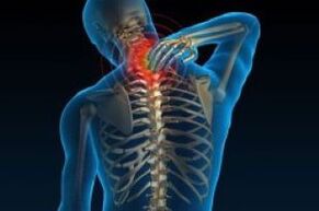 Servikal osteokondroz boyunda ağrıya yol açar