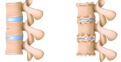 Lomber'in osteokondrozunun varlığı nasıl tanınır